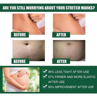 30g Pregnancy Stretch Mark Repair Cream Maternity Obesity Sk