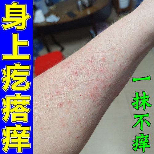 身上起红点痒天冷皮肤粗糙痒一抓就起泡胳膊长疙瘩泛红外用乳膏