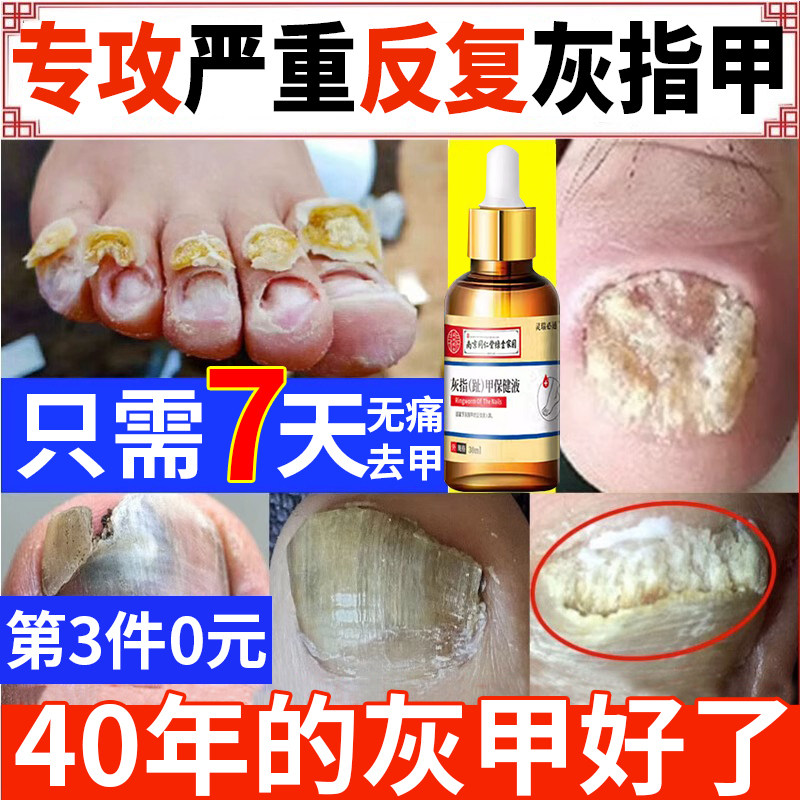 南京同仁堂灰指甲抑菌液特效打磨器冰醋酸30灰指甲抗菌护理盒AL怎么样,好用不?