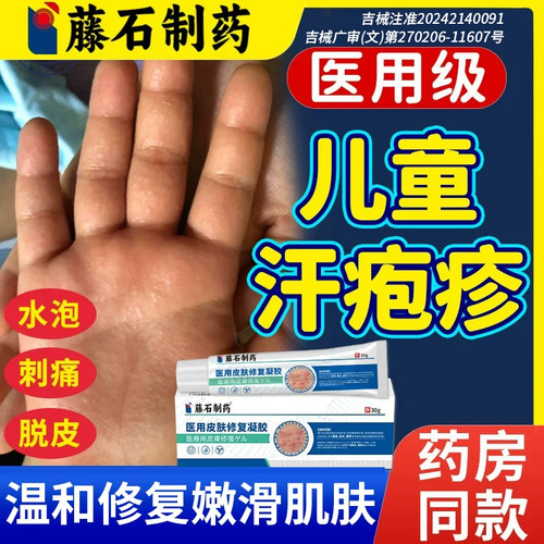 儿童汗疱疹膏手上起小水泡