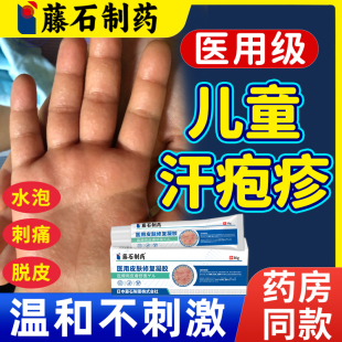 儿童汗泡汗状疱疹瘙痒手上起小水泡止痒汉状真菌感染药房同售WQ