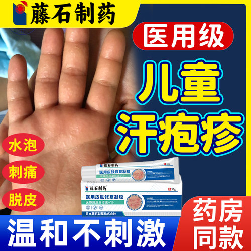 儿童汗疱疹膏手上起小水泡