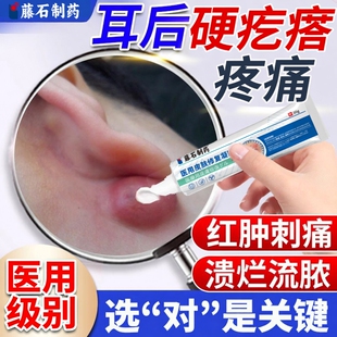 耳后鼓包硬块痘皮脂腺囊肿粉瘤疖肿拔毒拔脓专用火疖子敷料贴膏HT