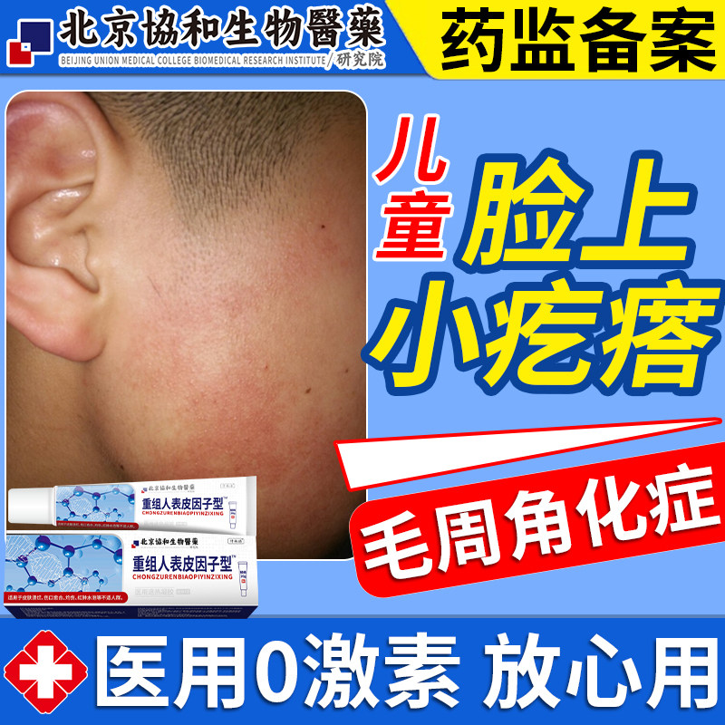 儿童毛周角化症脸部鸡皮肤疙瘩毛囊角化小孩脸上有小颗粒去除wq