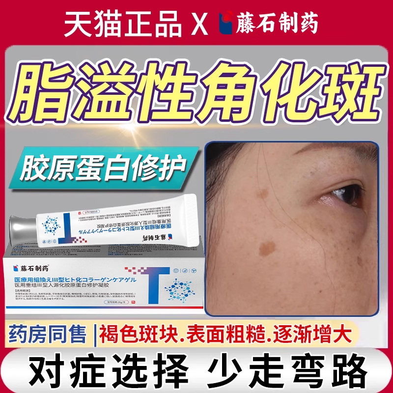 藤石制药脂溢性角化斑去老年斑