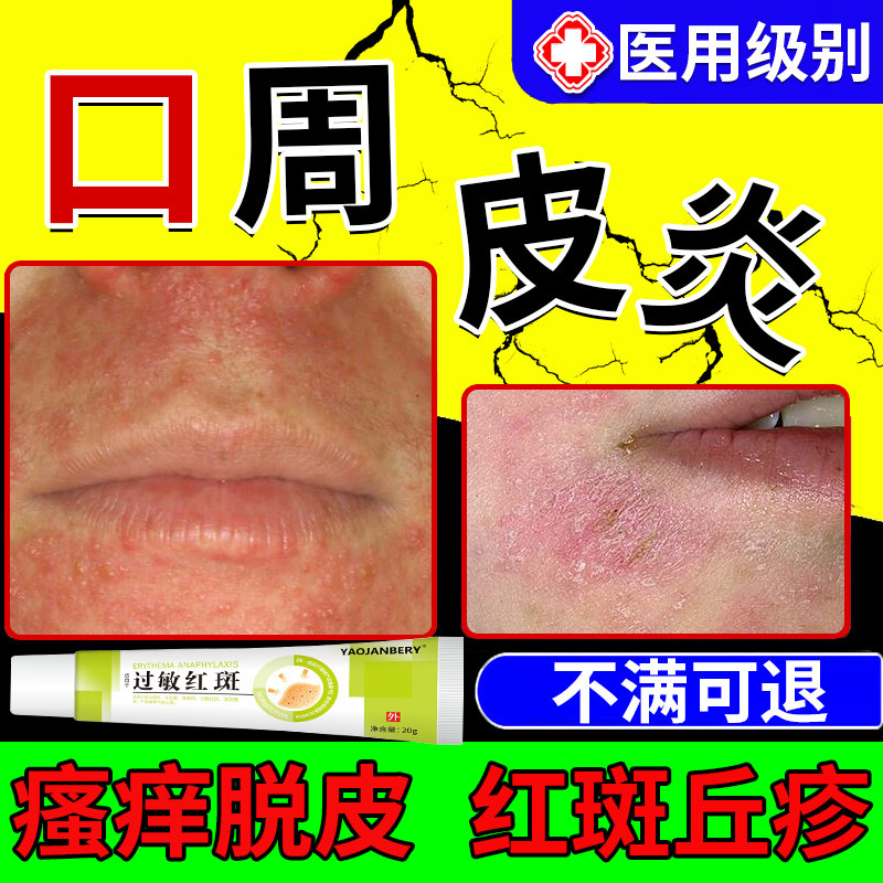 口周皮炎过敏红斑红肿唇周炎专用膏下巴痒脱屑可搭脂溢性药膏用aa