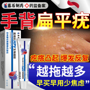手背上扁平疣去除一抹灵hpv去疣专用根干扰素b2凝胶药房同售膏DS