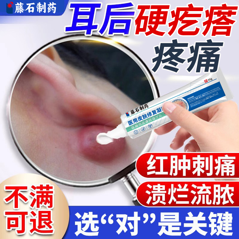 耳后耳郭火疖子囊肿粉瘤红肿硬块
