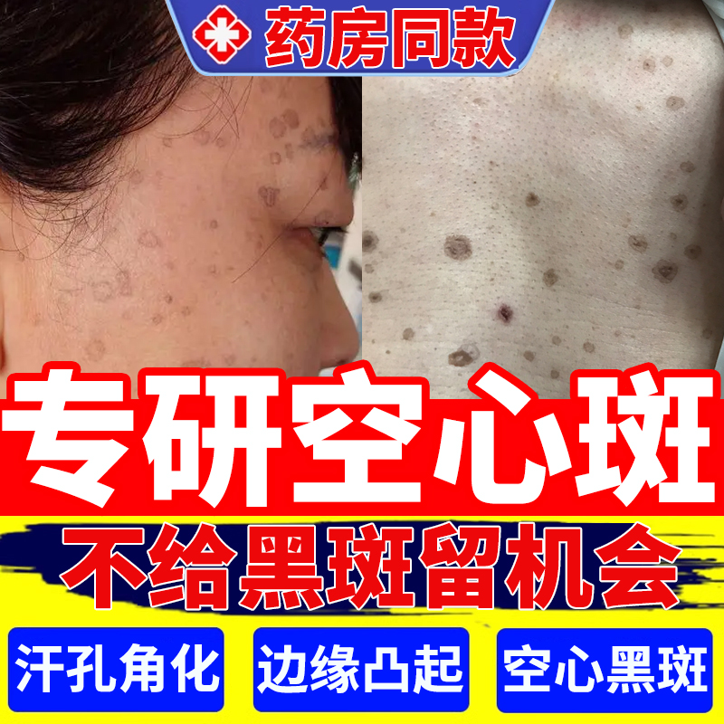 空心斑汗孔角化症黑色素沉淀膏