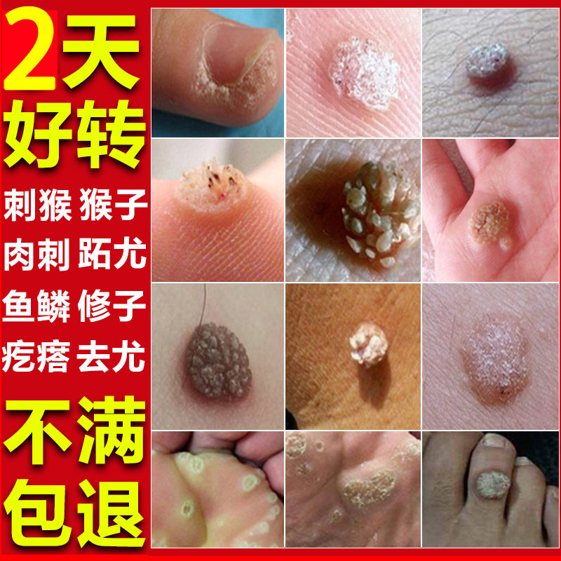治瘊子药刺猴去除正品手肉刺膏猴子神器肉粒疙瘩疣瘊肉粒一抹无忧