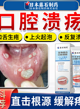 口腔溃疡专用可搭牙膏牙周炎喷剂防口舌生疮上火起泡牙龈护理AZ