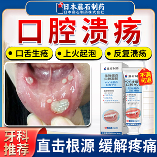 口腔溃疡专用可搭牙膏牙周炎喷剂防口舌生疮上火起泡牙龈护理AZ