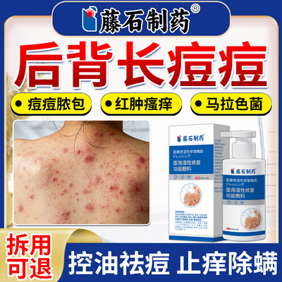 后背长痘痘沐浴露去除背上毛囊痘痘前胸后背炎可搭配药膏喷剂AZ