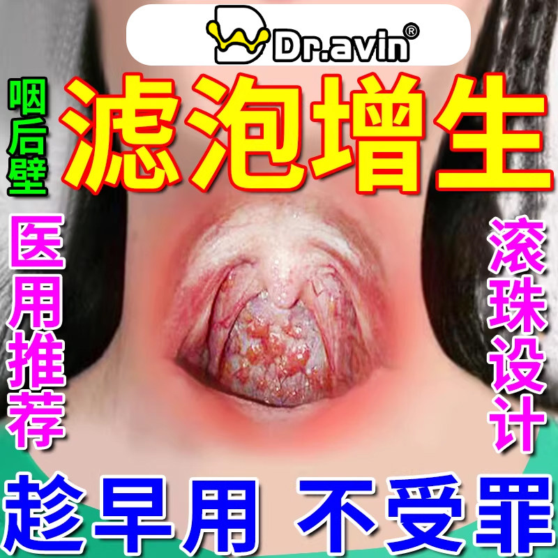 Dr.avin咽后壁淋巴滤泡增生慢性咽炎咽喉炎异物感喷雾剂喉咙BD