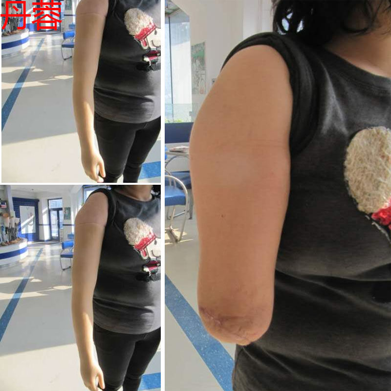 丹蓉德国进口硅胶假肢前臂上臂加长美容手皮义肢断肢残疾人背带款