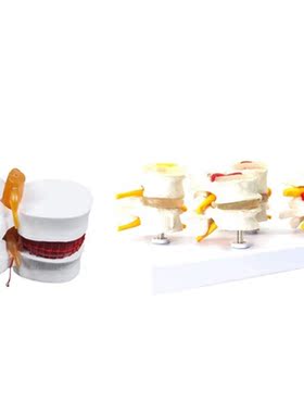 1 Pcs Skeleton Spine Lumbar Disc Herniation Teaching Model &