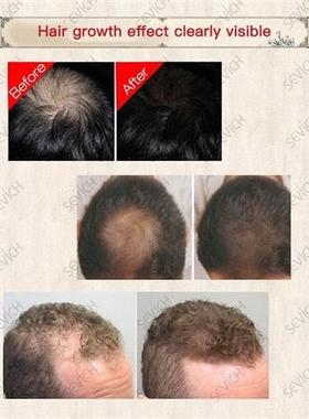 30ml Hair Natural Faer Growing Spray Hair Loss treatment