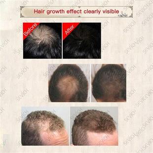30ml Hair Natural Faer Growing Spray Hair Loss treatment