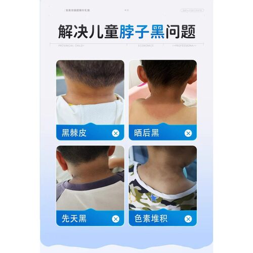 儿童祛脖子黑色素去除沉淀小孩黑棘皮症后颈部皮肤嫩白霜男女孩