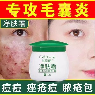 手臂大腿后背脸上皮毛囊炎下身体私处专硬疙瘩胸部用祛痘痘中药膏