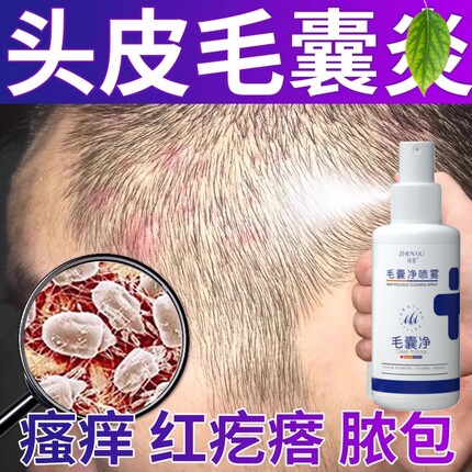 毛囊净喷剂药头皮毛囊头上长痘痘头痒有疙瘩马拉色菌头部老牌子焱