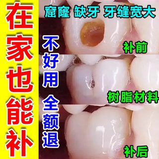 补牙齿神器材料永久自己在家补牙堵堵牙洞膏牙缝3m进口蛀牙树脂