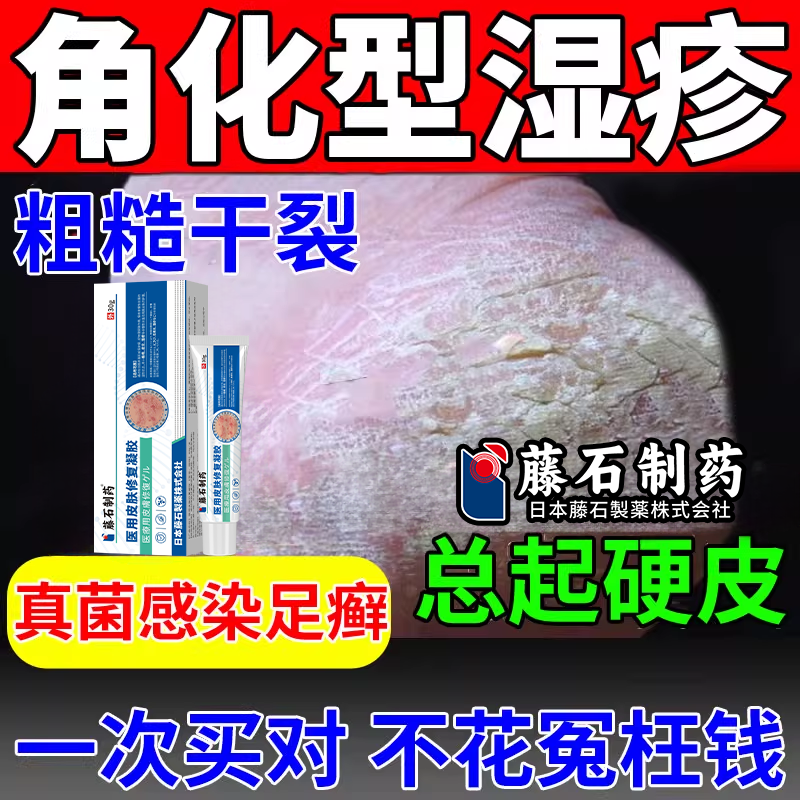 角化型湿疹脚气脚后跟开裂起硬皮