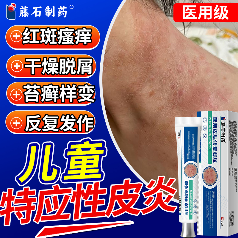 儿童特应性皮炎止痒专用凝胶药房同售软膏去皮肤干燥脱屑瘙痒根QK