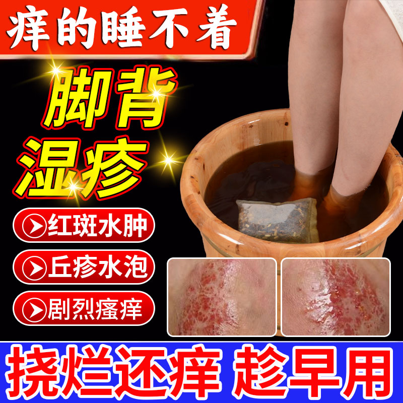 脚部湿疹脚背止痒去专用脚气膏干性皮疹根足癣真菌感染泡脚包ca