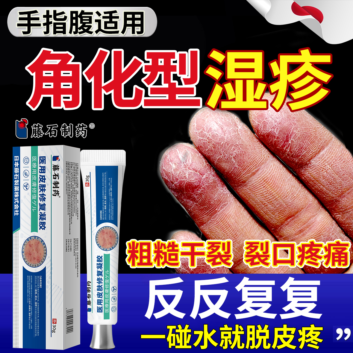 手指腹角化型湿疹手部湿疹癣膏手癣干燥脱屑真菌感染药房同售中QK