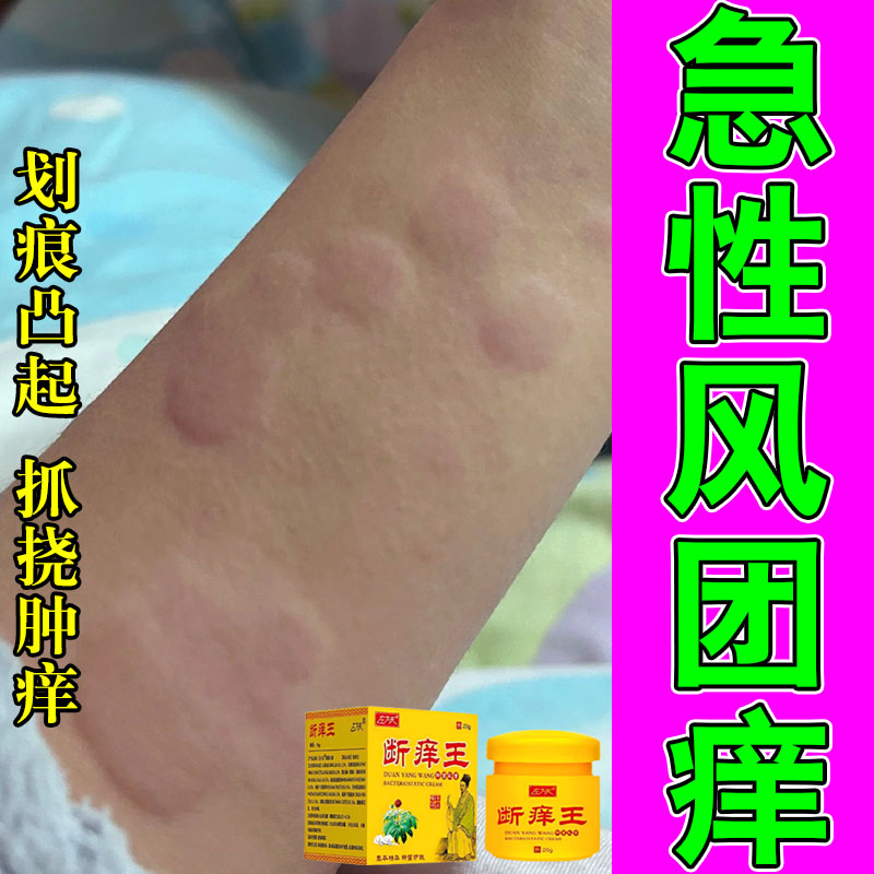 身上风团痒皮肤大面积发痒起疙瘩抓痕红肿刺挠舒缓修护膏