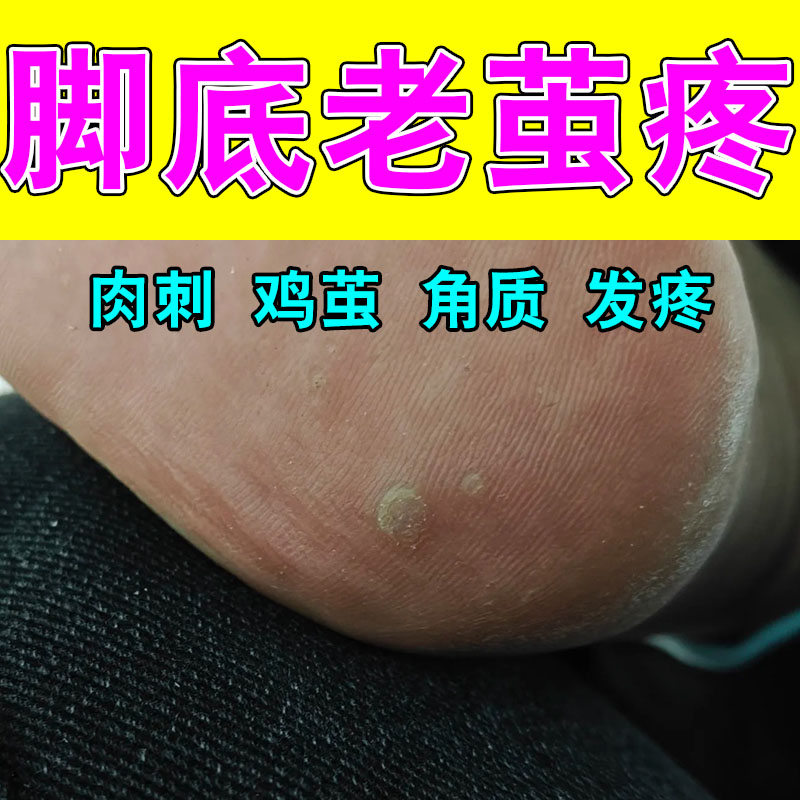 脚底老茧脚垫脚后跟厚茧脚趾关节茧子足部角质护理修护贴