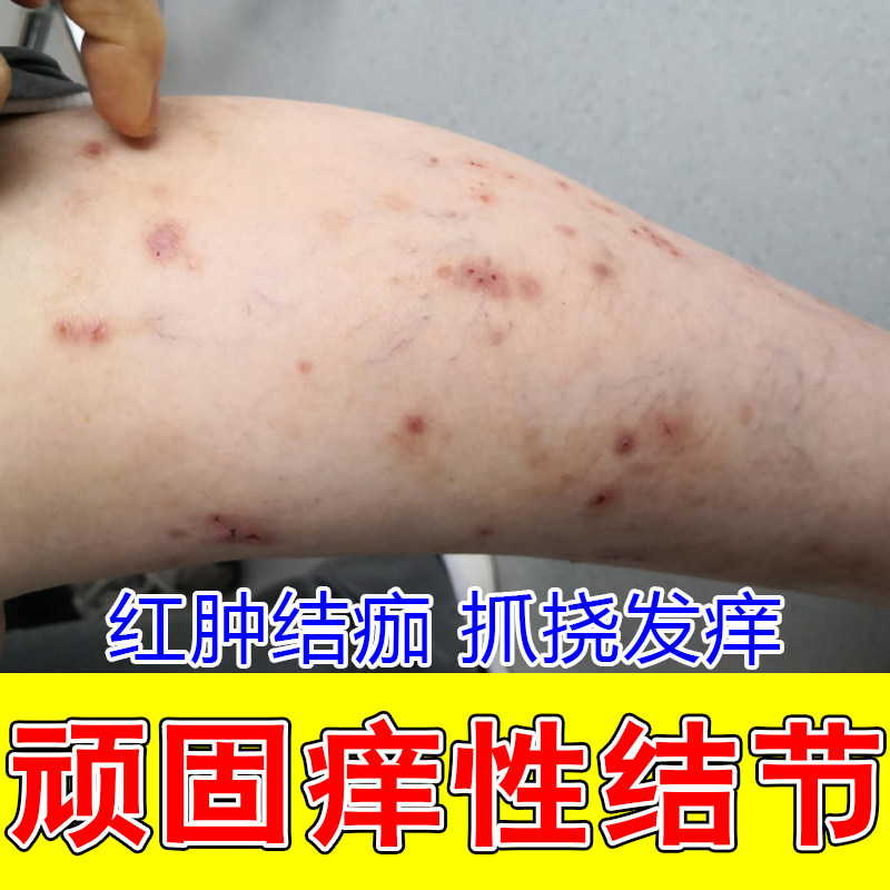 结节性顽固硬疙瘩红肿硬块全身皮肤红斑疙瘩舒缓修护膏乳