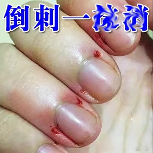 手指倒刺修复指甲边缘长肉刺防干燥脱皮出血破损专用滋养肌肤软膏