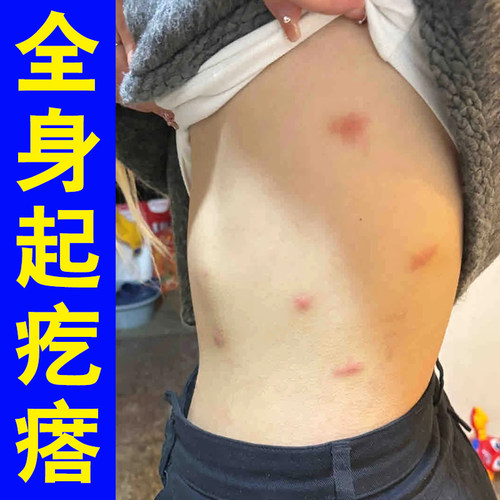 全身上起红疙瘩腿上皮肤刺挠长小红点干燥软膏