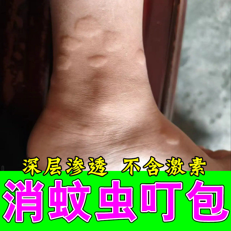 蚊虫叮咬痒胳膊腿上起疙瘩红肿刺痒红疙瘩凸起草本植物萃取喷剂