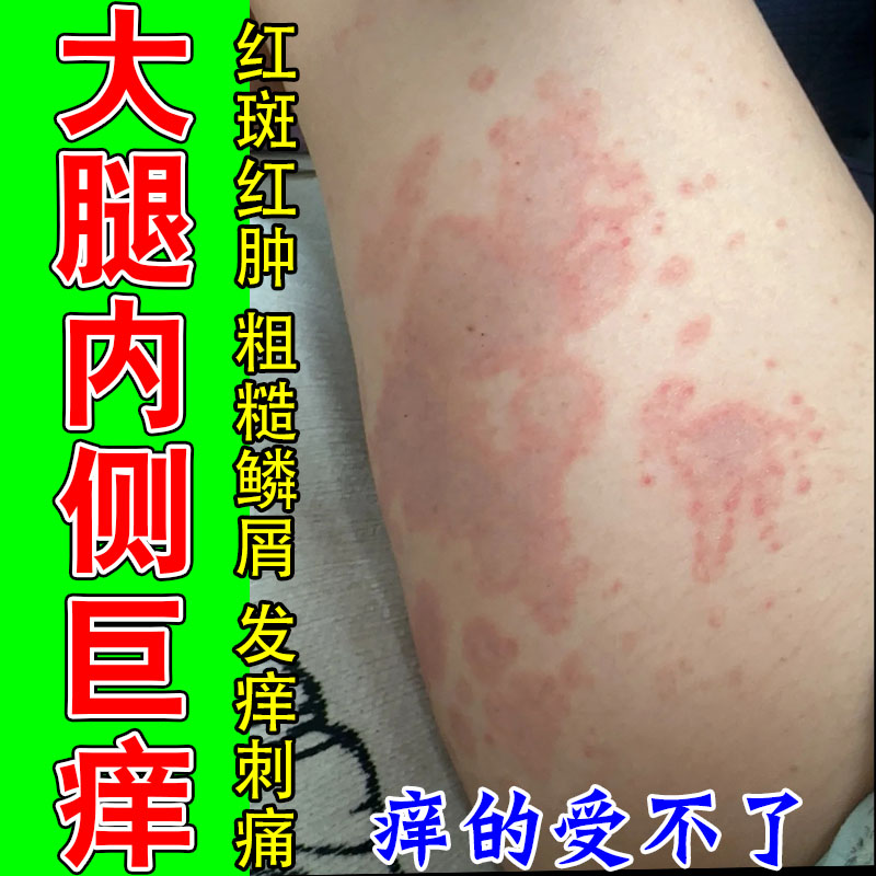 大腿内侧皮肤发痒私处真菌红斑大面积痒疙瘩湿痒干燥起屑修护膏
