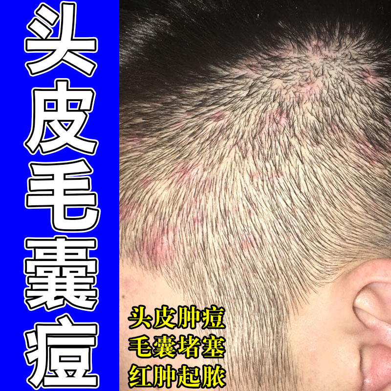 头皮疙瘩疼红肿长痘头皮毛囊冶后脑勺有疙瘩起红肿硬块草本舒缓膏