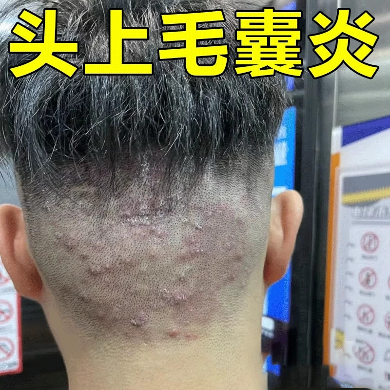 头上长痘痘脓包疙瘩头毛囊炎脓包毛囊发炎堵塞有硬块红肿专用膏