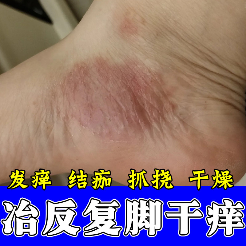 脚侧面疙瘩红痒神经性皮肤痒脚侧痒刺挠真菌脱皮粗糙干痒红修护膏