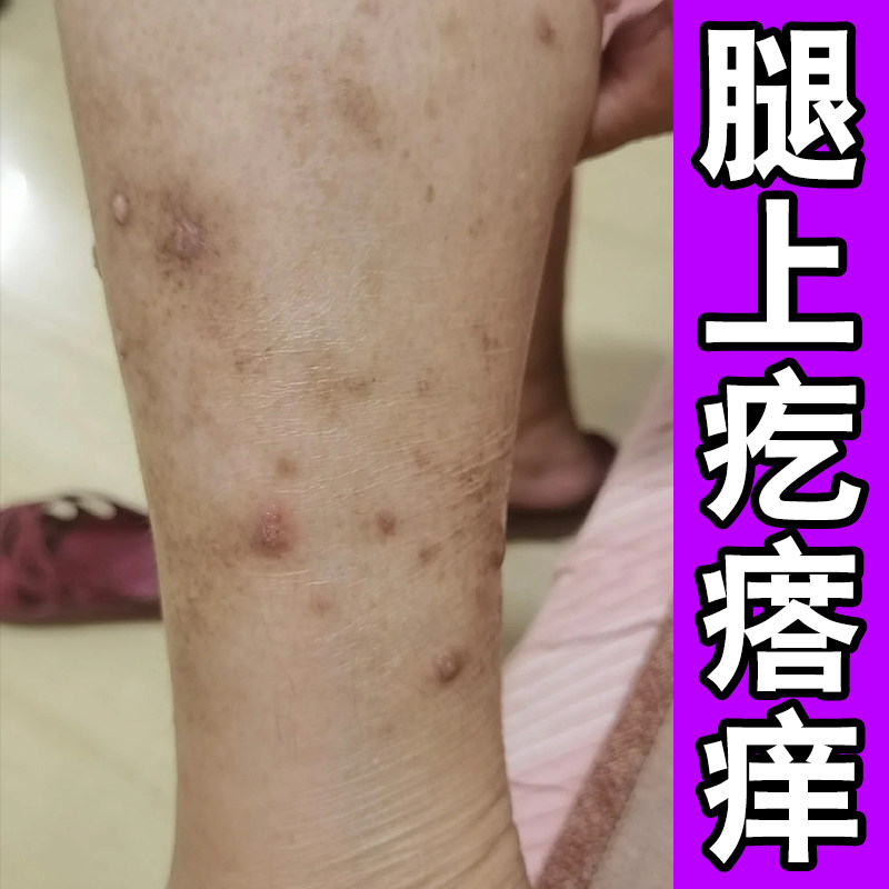 疙瘩小腿上胳膊起小红点红肿结痂溃烂干燥外用膏
