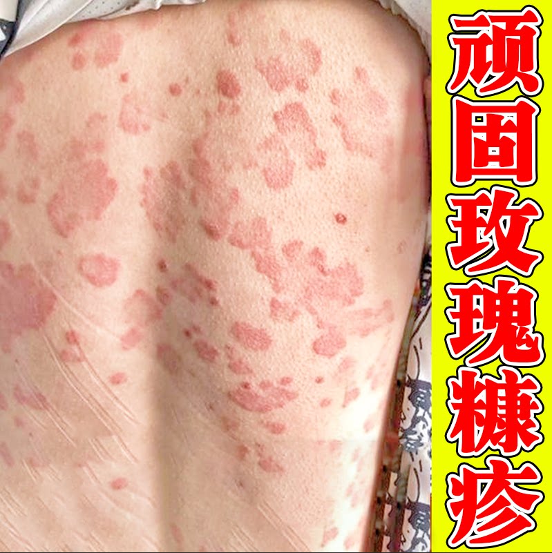 后背上长红色红点腿上胳膊汗斑花斑