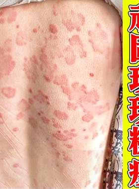 玫瑰糠疹专用根药除后背上长红色疹子皮肤过敏去汗斑花斑膏