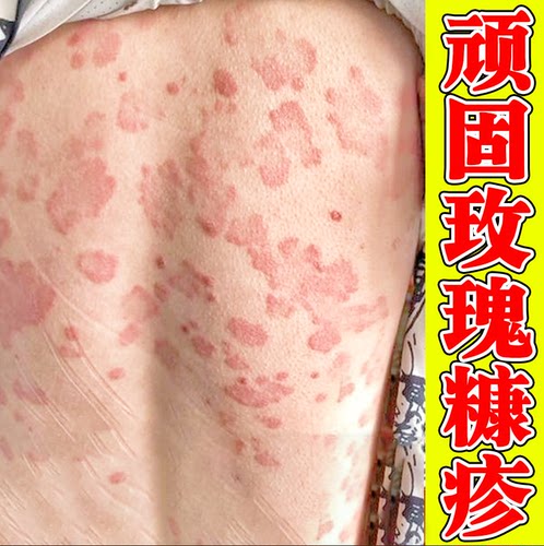 后背上长红色红点腿上胳膊汗斑花斑
