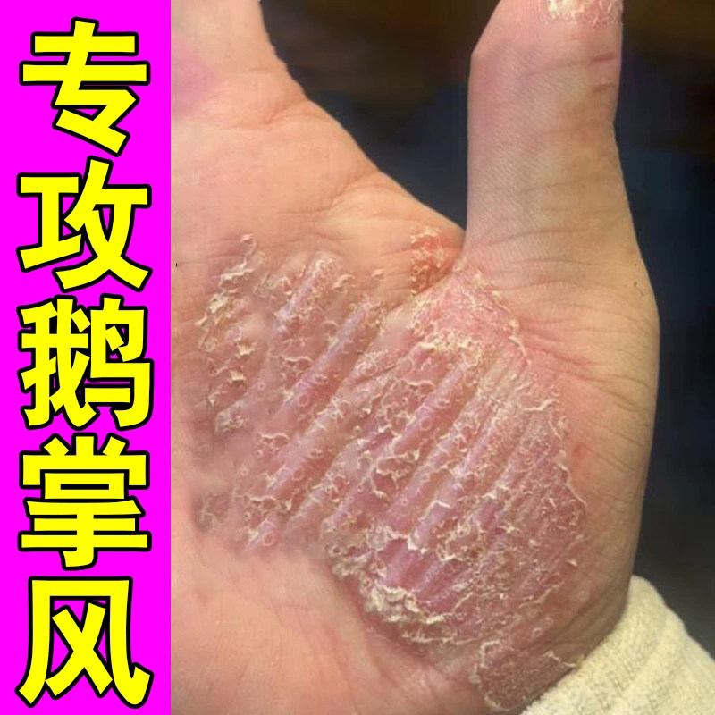 硬皮膏脱皮干裂手掌心季节性脱皮角质增厚起皮掉屑粗糙