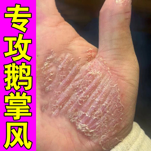 硬皮膏脱皮干裂手掌心季节性脱皮角质增厚起皮掉屑粗糙