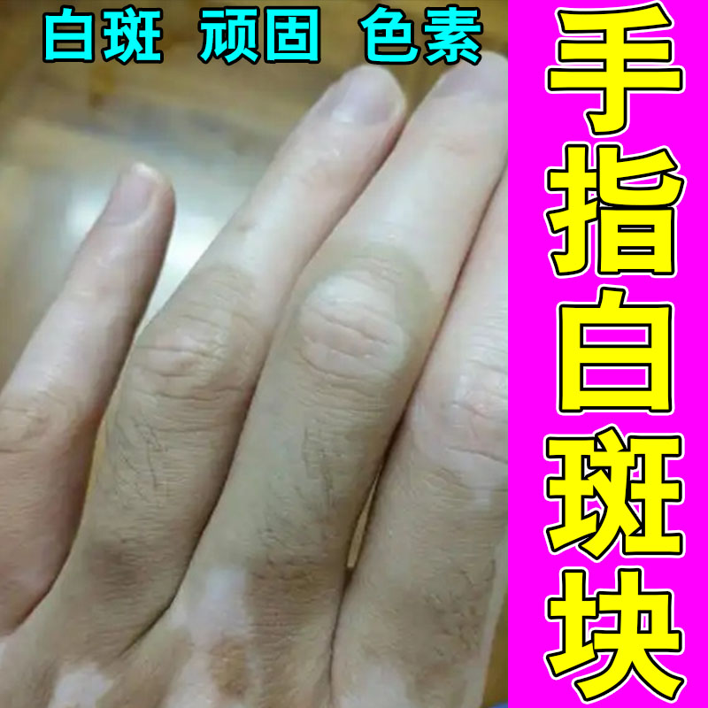 手上白斑黑色素生长手背身上皮肤长白色斑修护植物膏乳