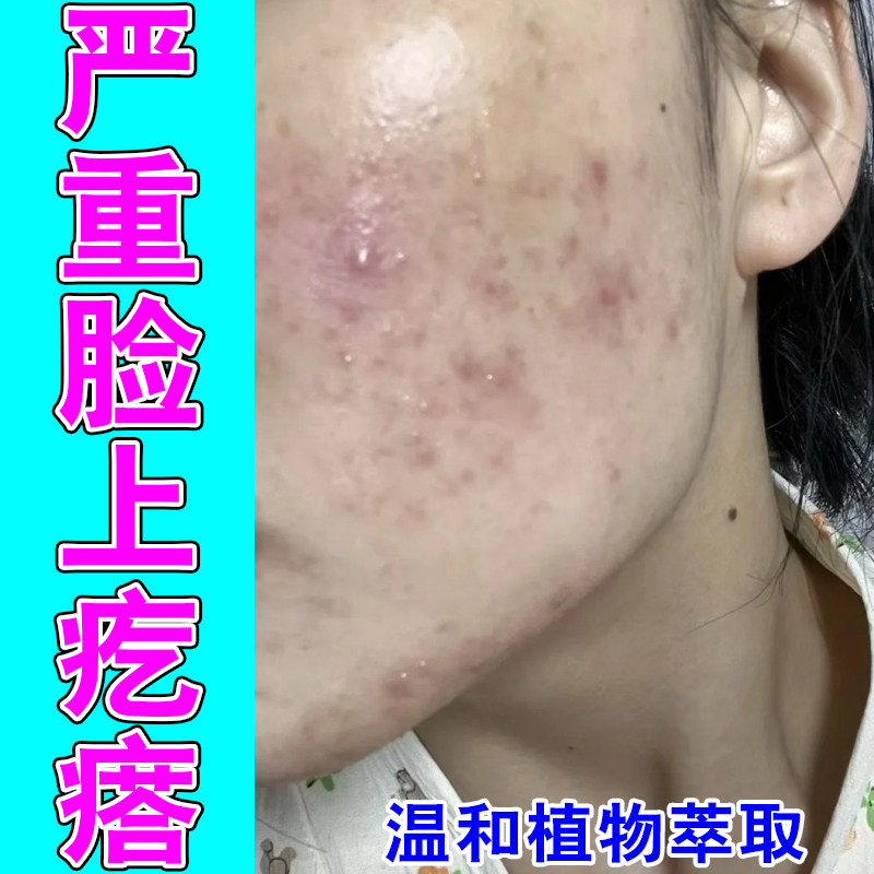 面部反复红肿硬痘起皮粗糙草本萃取成人粉刺疙瘩修护舒缓乳霜