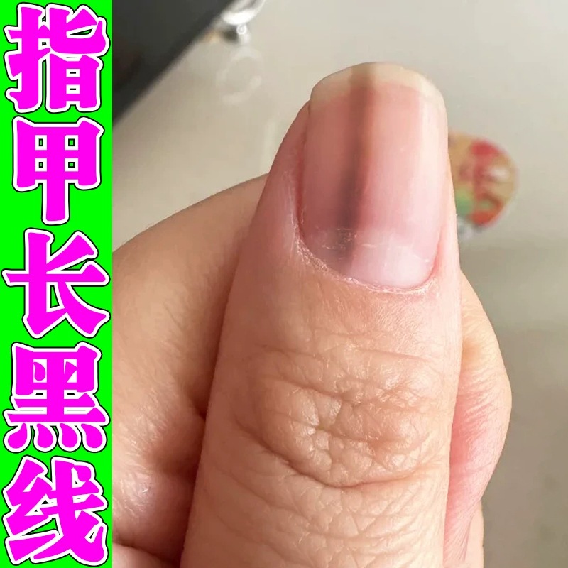 指甲里面有黑色竖纹淤血指甲黑线手指染凹凸不平灰指甲膏指甲修复