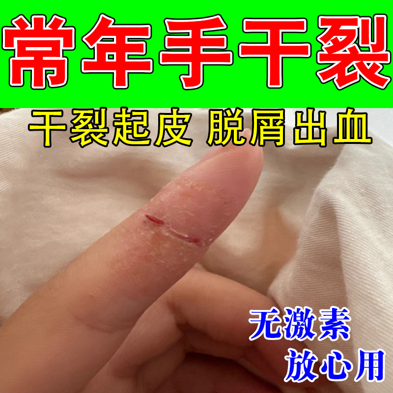手指头裂口子脱皮开裂手干燥起皮屑粗糙起硬皮疼痛保湿修护膏